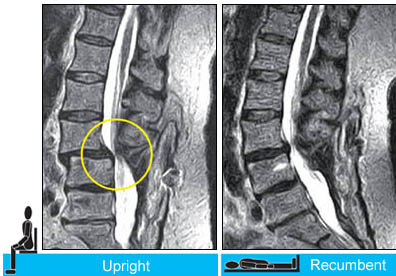 Case #1: Postoperative Hypermobile Instability